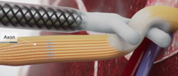 cryo nerve block amputation