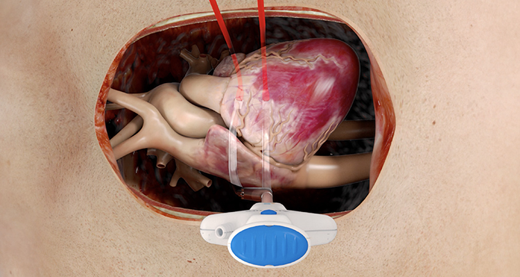 Isolator Synergy EnCompass Clamp procedure