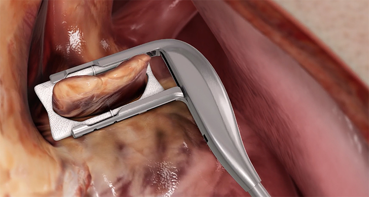 AtriClip flex-mini device procedure