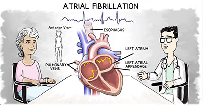 Atrial Fibrillation graphic