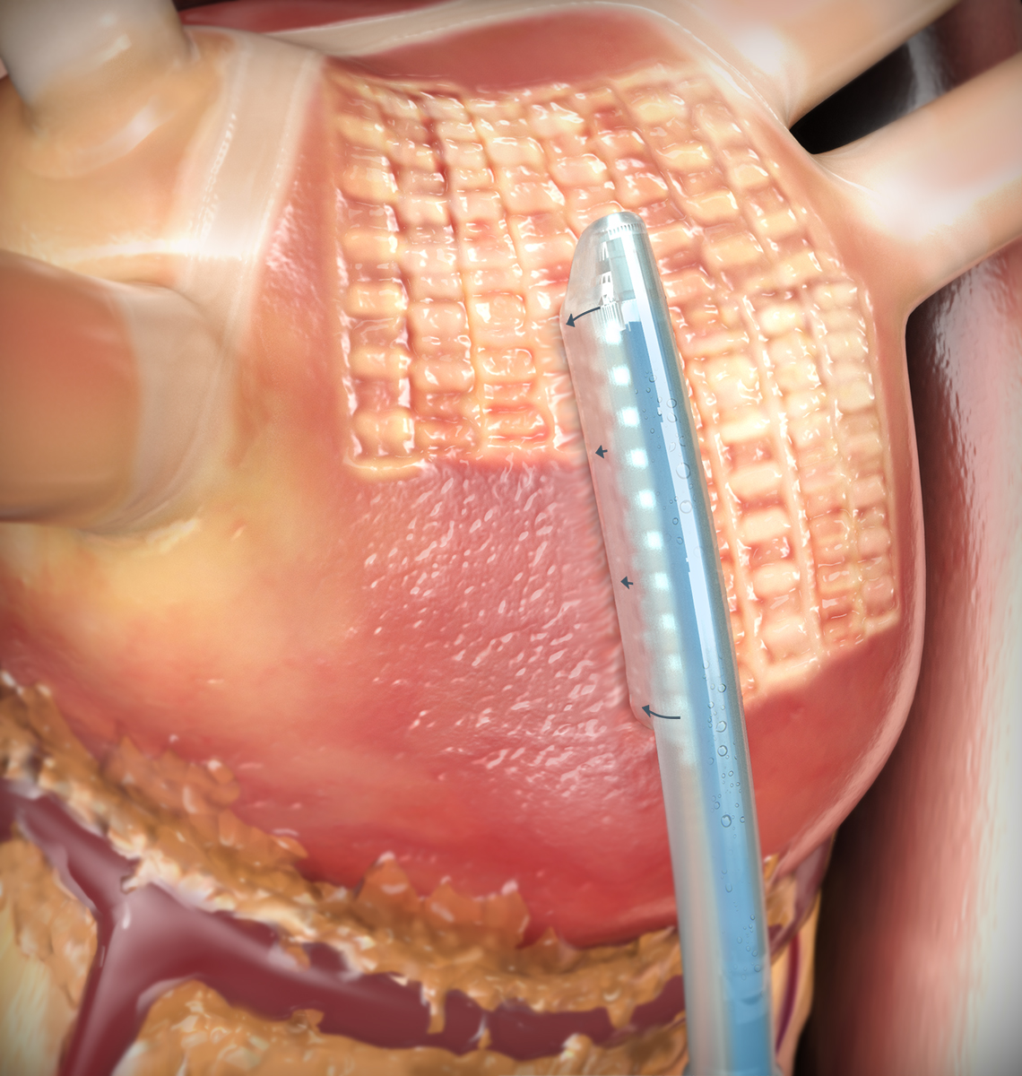 Epicardial ablation