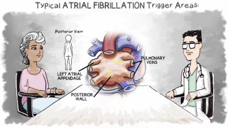 Atrial Fibrillation trigger area graphic