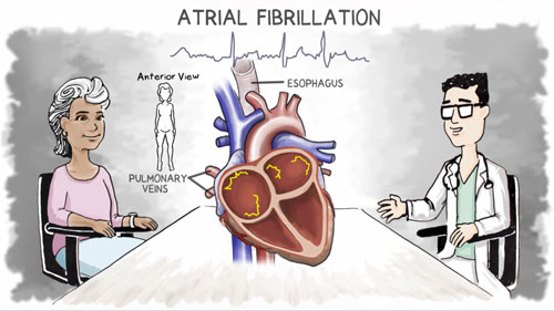 Atrial Fibrillation graphic