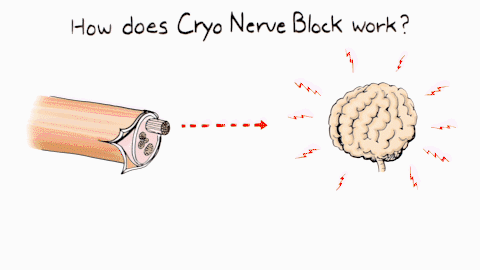 Cryo Nerve Block graphic
