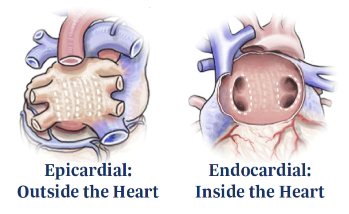 Image showing Endocardial and Epicardial