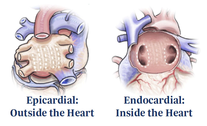 Ablation Treatment for Afib