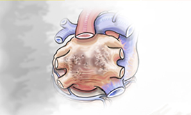 Longstanding Persistent Afib - heart