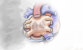 Persistent Afib - heart